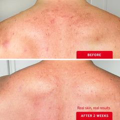 Body Acne Clearing Mist with 2% Salicylic Acid