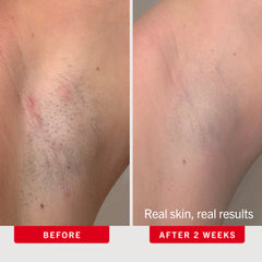 Ingrown Hair Pads with BHA + AHA 60 count